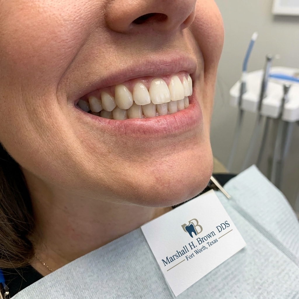 Close-up of a patient's smile showing multiple natural-looking tooth-colored composite resin fillings that are completely undetectable compared to surrounding tooth structure at Marshall H. Brown DDS Fort Worth Texas